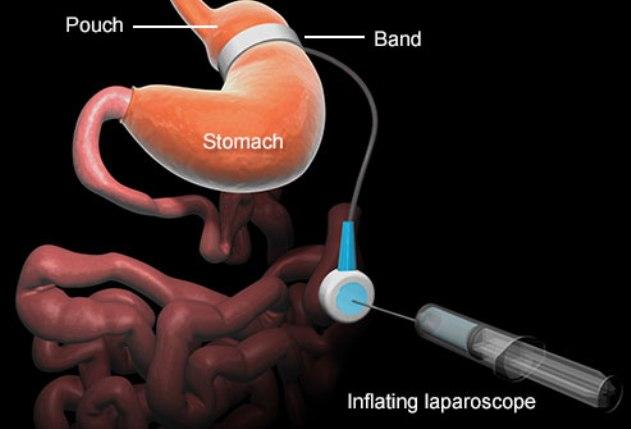 Adjustable Gastric Banding Weight Loss Surgery
