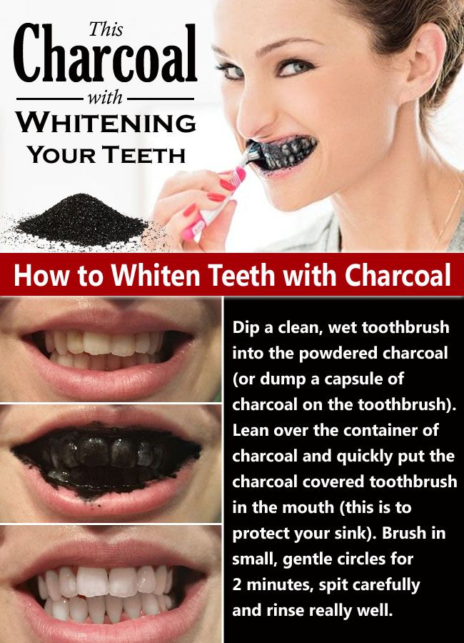 Best dental whitening procedure