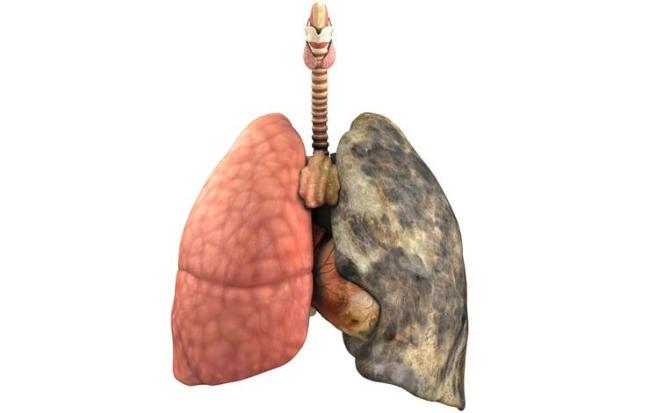 Chronic Lower Respiratory Diseases Causes