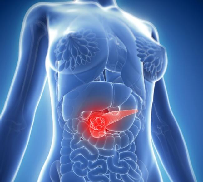 Pancreatitis and Pancreatic Cancer Symptoms